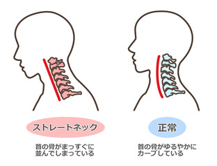 ストレートネック